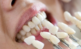 dental veneers crowns bridges