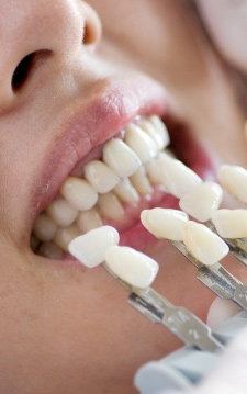 teeth-whitening-dentist-camberwell