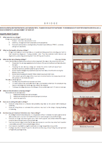 dentist-camberwell-info-Veneer