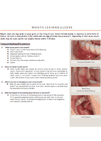 dentist-camberwell-info-Ulcers
