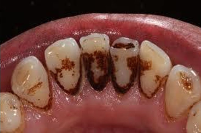 What causes teeth to stain or discolour? Hartwell